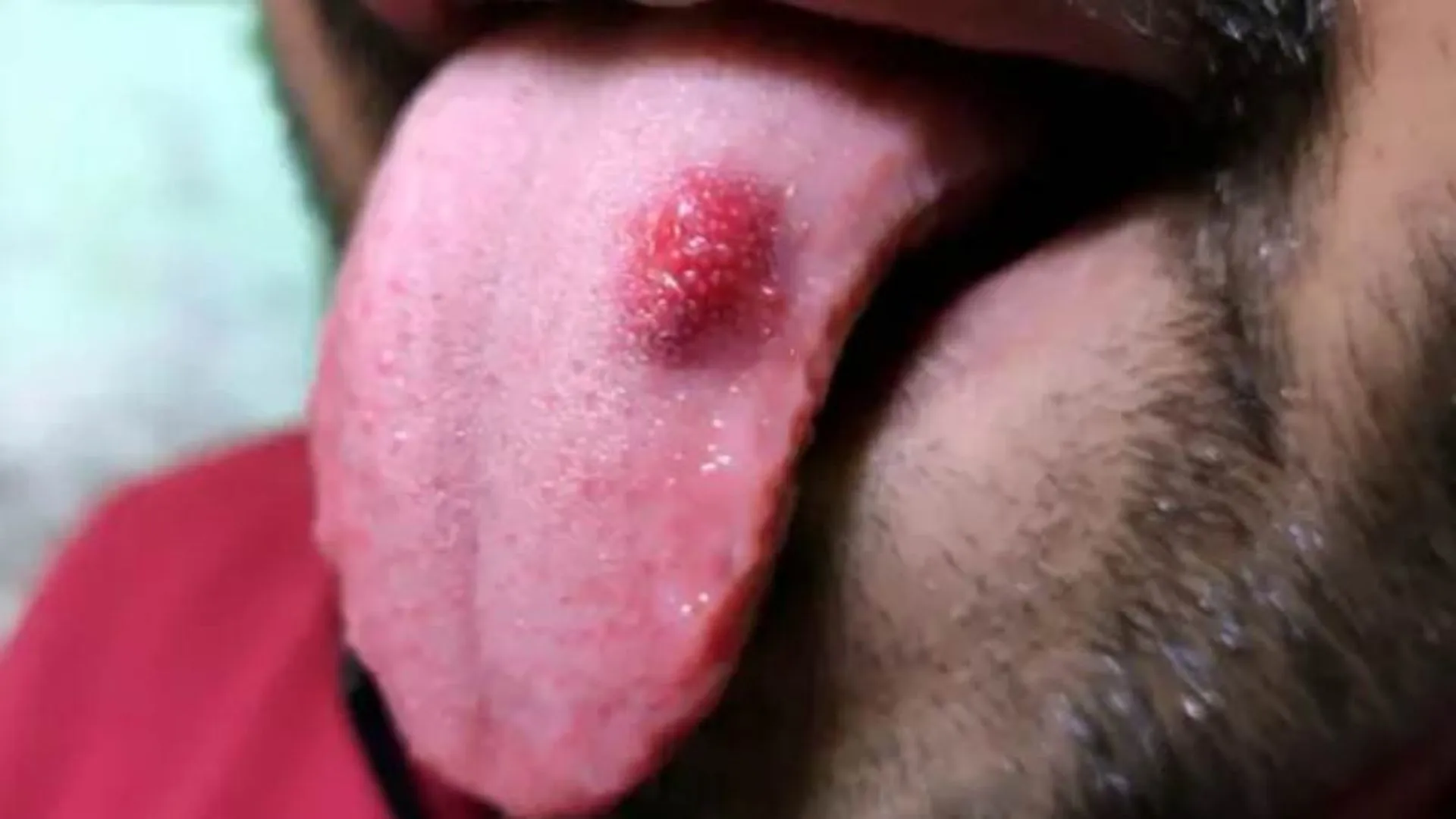 Dấu hiệu sùi mào gà ở lưỡi trong các giai đoạn và phân loại bệnh