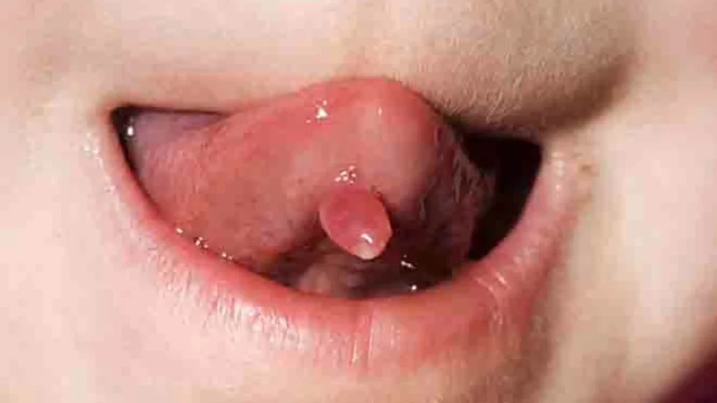 Dấu hiệu sùi mào gà ở lưỡi trong các giai đoạn và phân loại bệnh