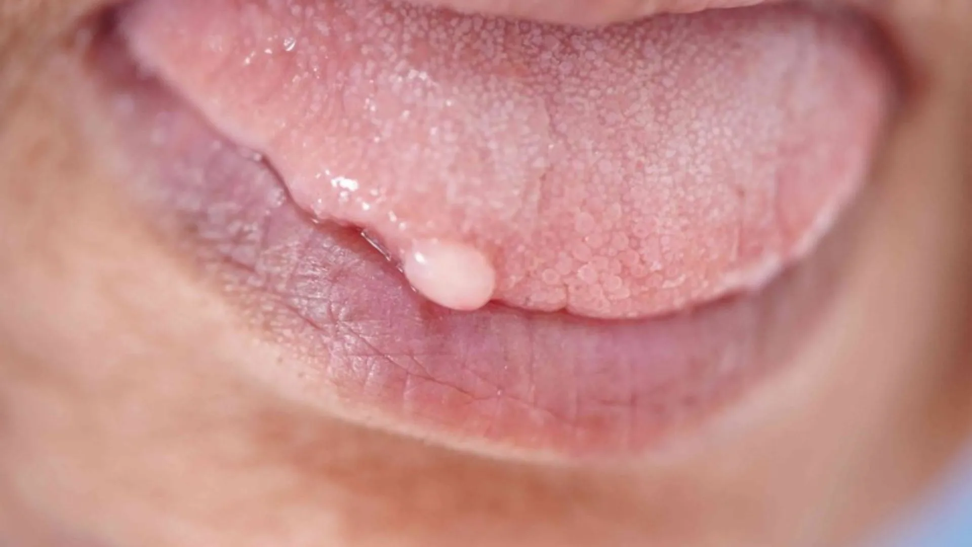 Dấu hiệu sùi mào gà ở lưỡi trong các giai đoạn và phân loại bệnh