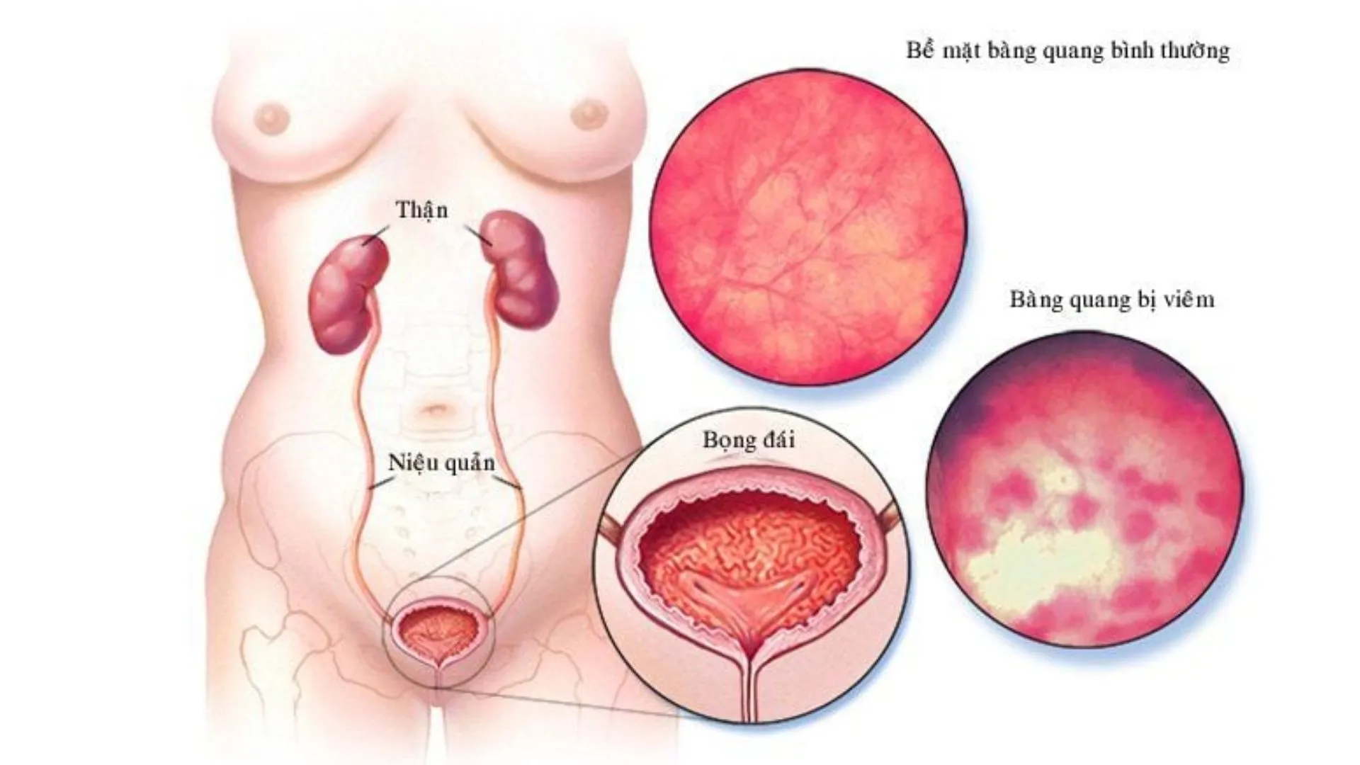Điều trị viêm bàng quang cấp bằng các phương pháp nào hiệu quả?