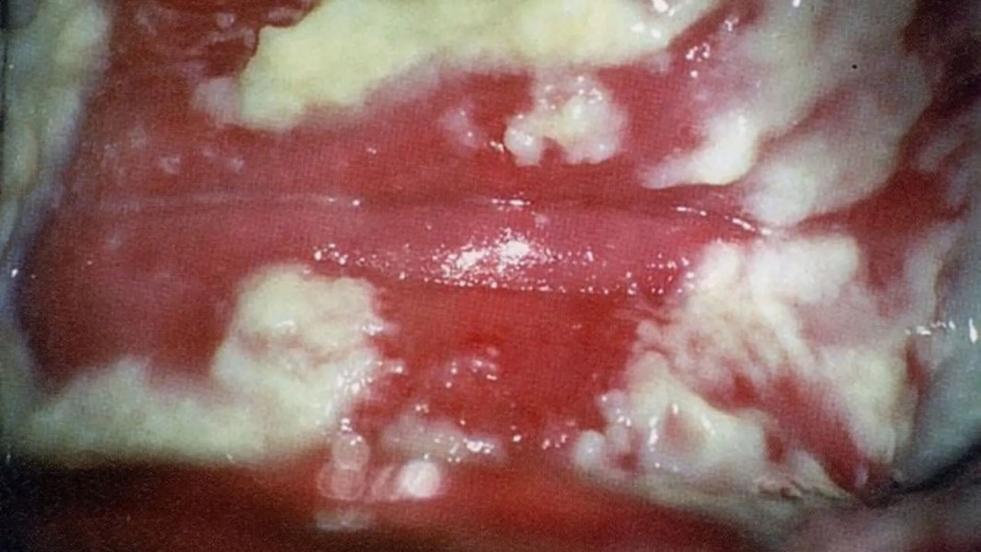 Nấm âm đạo là gì? Nguyên nhân, triệu chứng bệnh và phòng ngừa hiệu quả