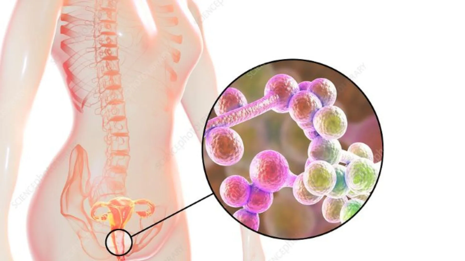 Nấm âm đạo là gì? Nguyên nhân, triệu chứng bệnh và phòng ngừa hiệu quả