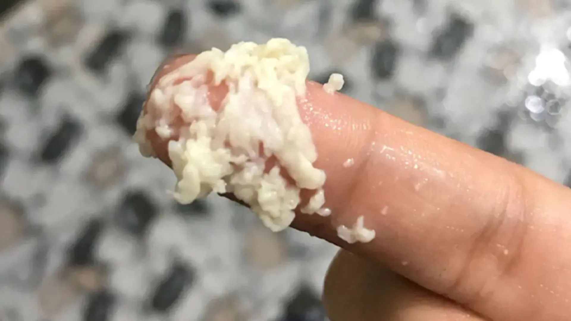 Nhiễm nấm âm đạo có dấu hiệu và biến chứng gì? Các điều trị tốt nhất 