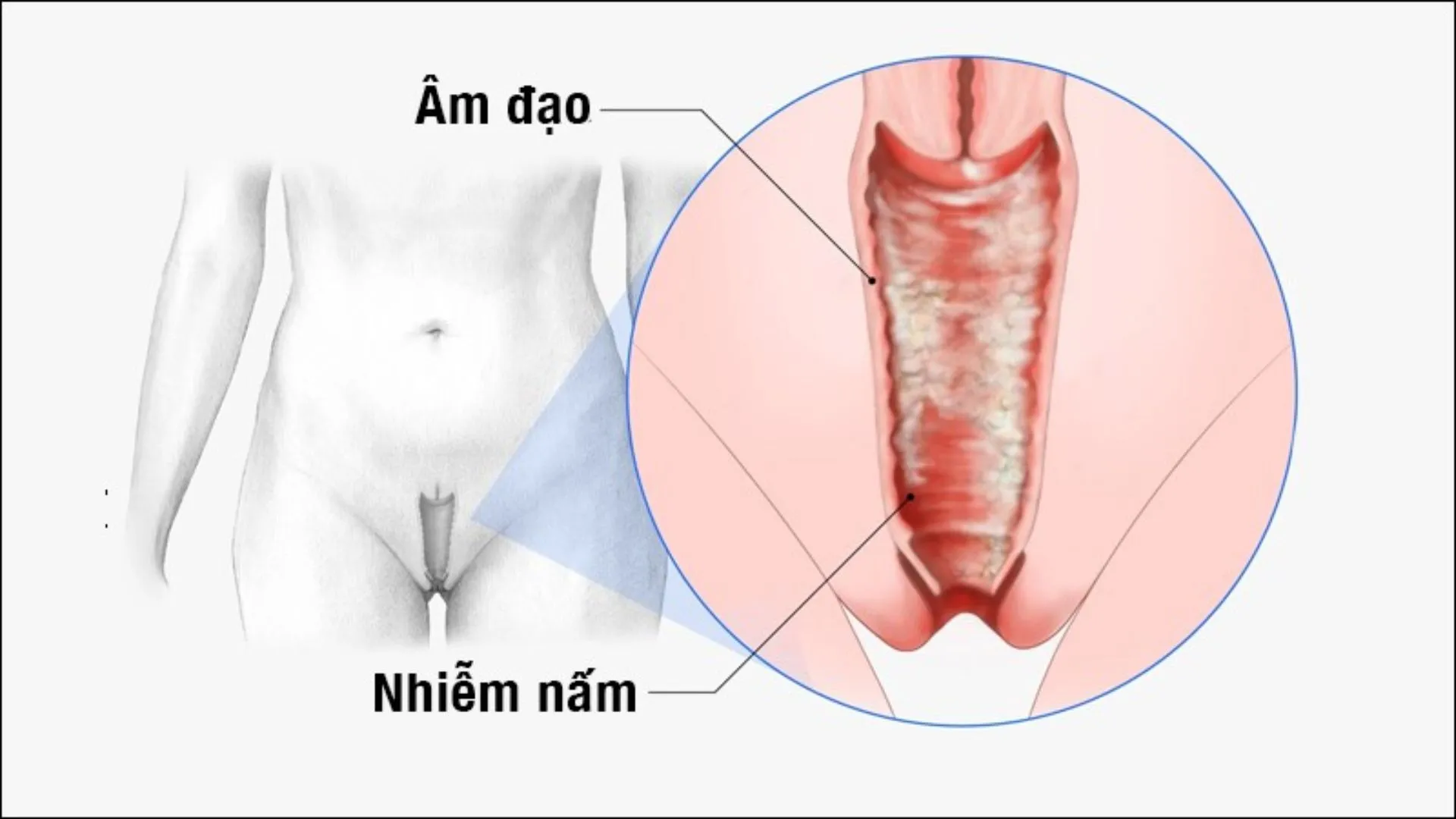 Nhiễm nấm âm đạo có dấu hiệu và biến chứng gì? Các điều trị tốt nhất 
