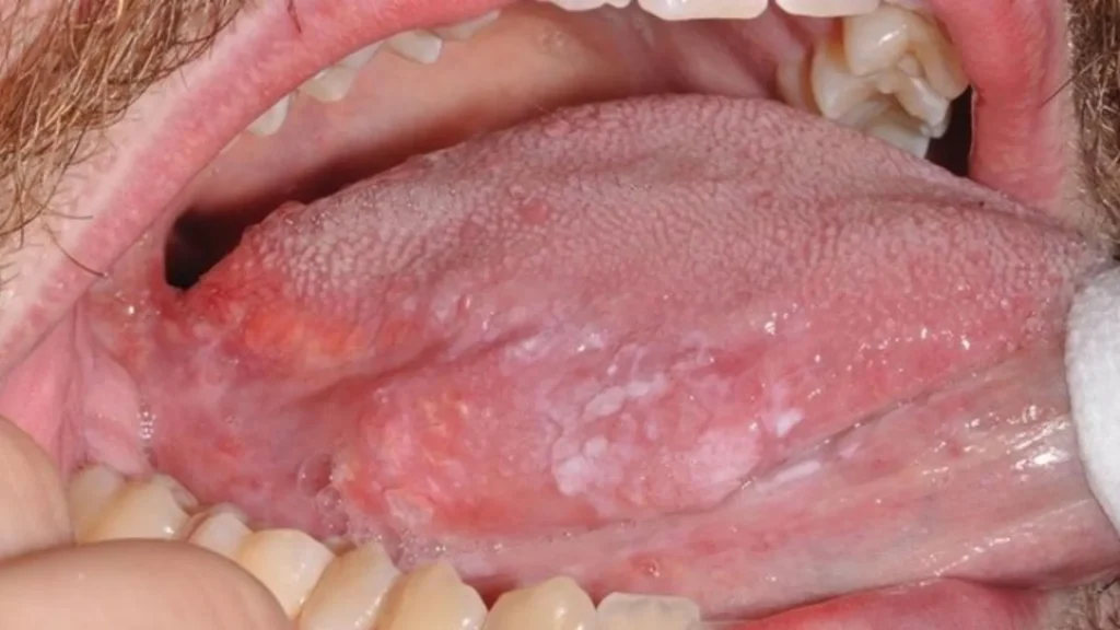 So sánh sùi mào gà ở miệng và nhiệt miệng khác nhau như thế nào?