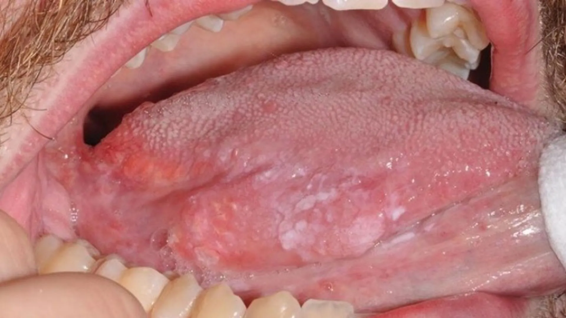 So sánh sùi mào gà ở miệng và nhiệt miệng khác nhau như thế nào?