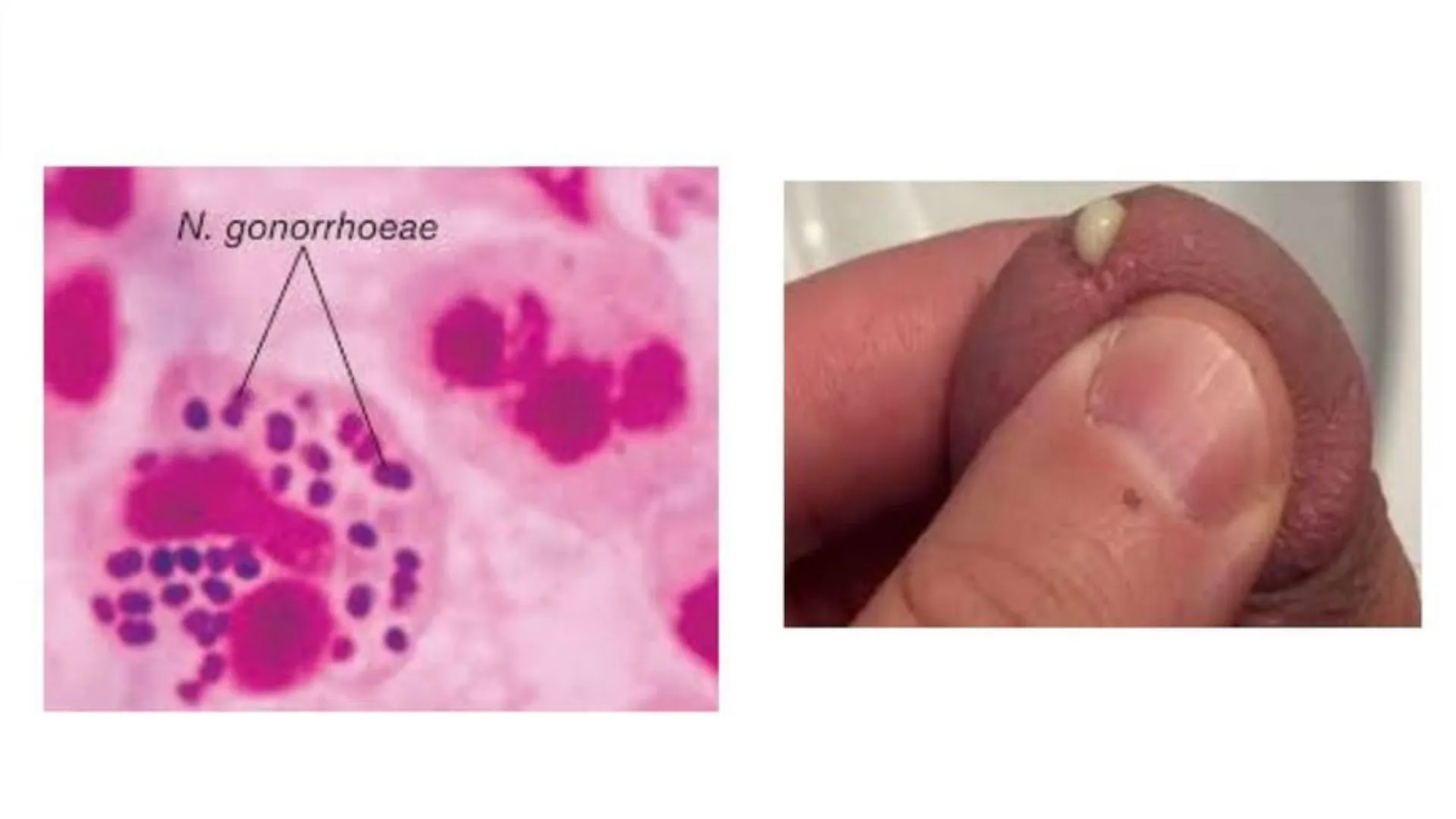 Niệu đạo có mủ là gì? Nguyên nhân và triệu chứng của bệnh hiện nay 