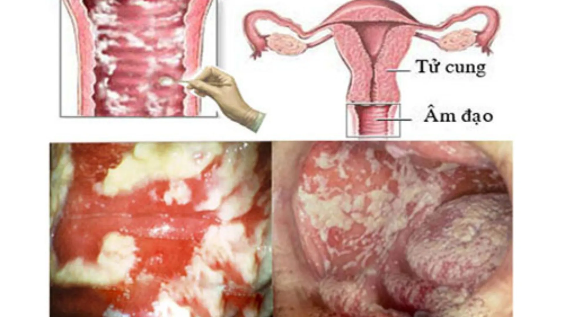 Niệu đạo có mủ là gì? Nguyên nhân và triệu chứng của bệnh hiện nay 