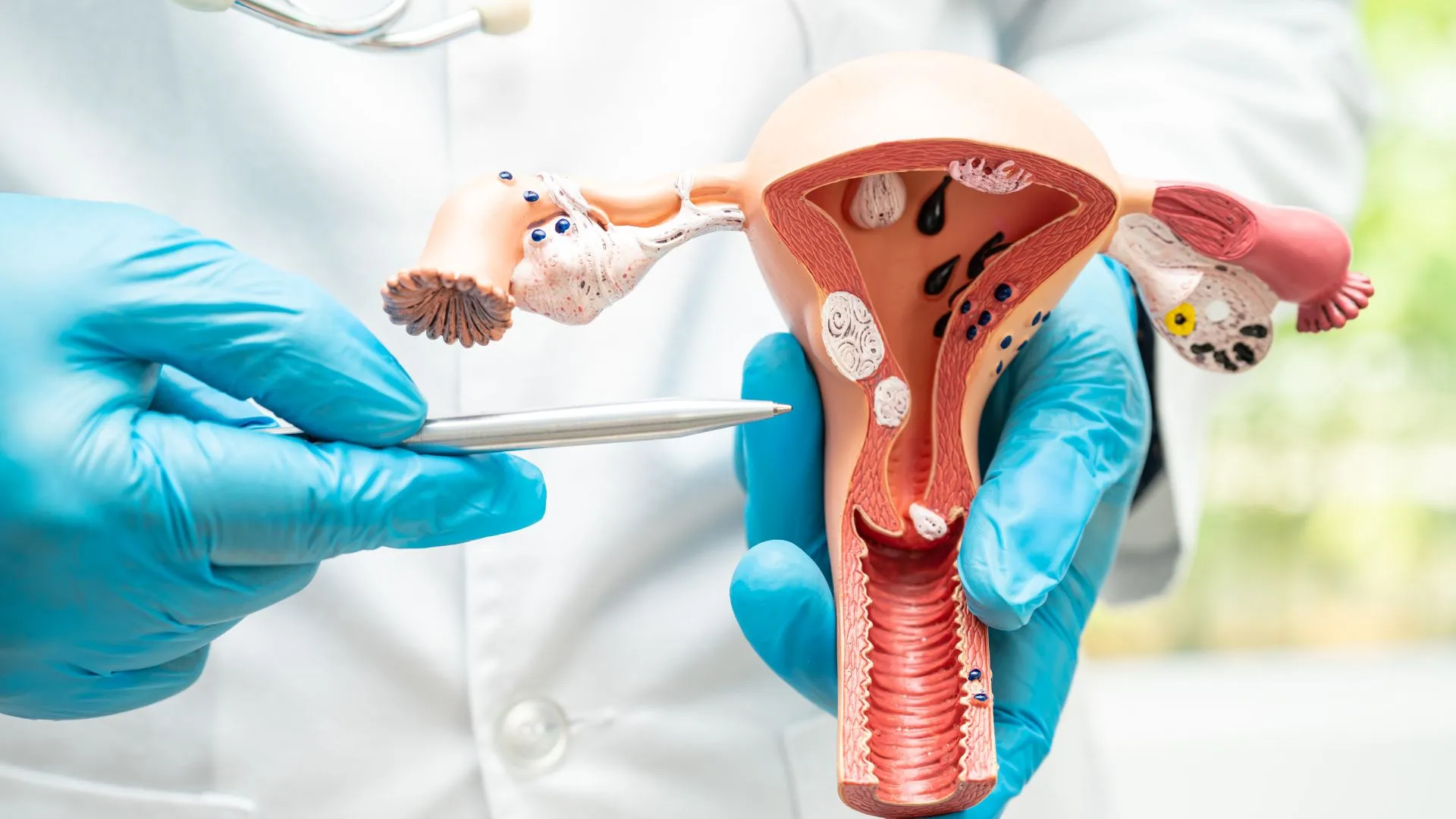 Sàng lọc ung thư cổ tử cung với bằng phương pháp hiệu quả hiện nay