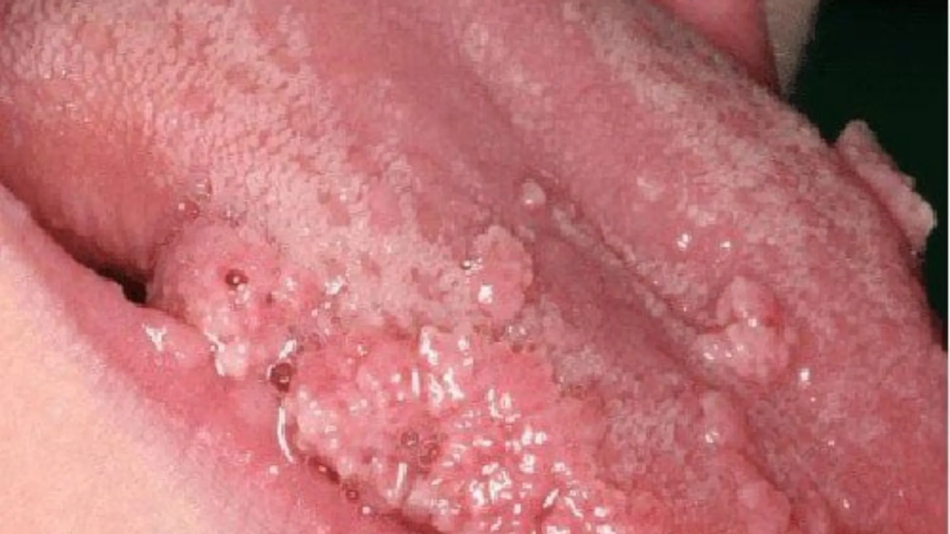 Sùi mào gà ở lưỡi và tất tần tật những gì bạn cần phải biết để tránh