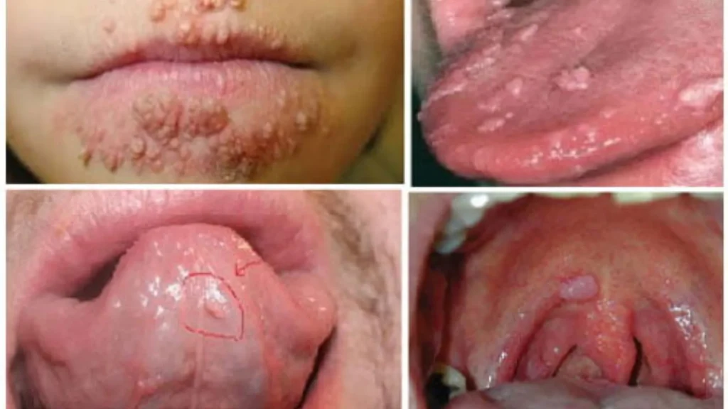 Sùi mào gà ở lưỡi và tất tần tật những gì bạn cần phải biết để tránh