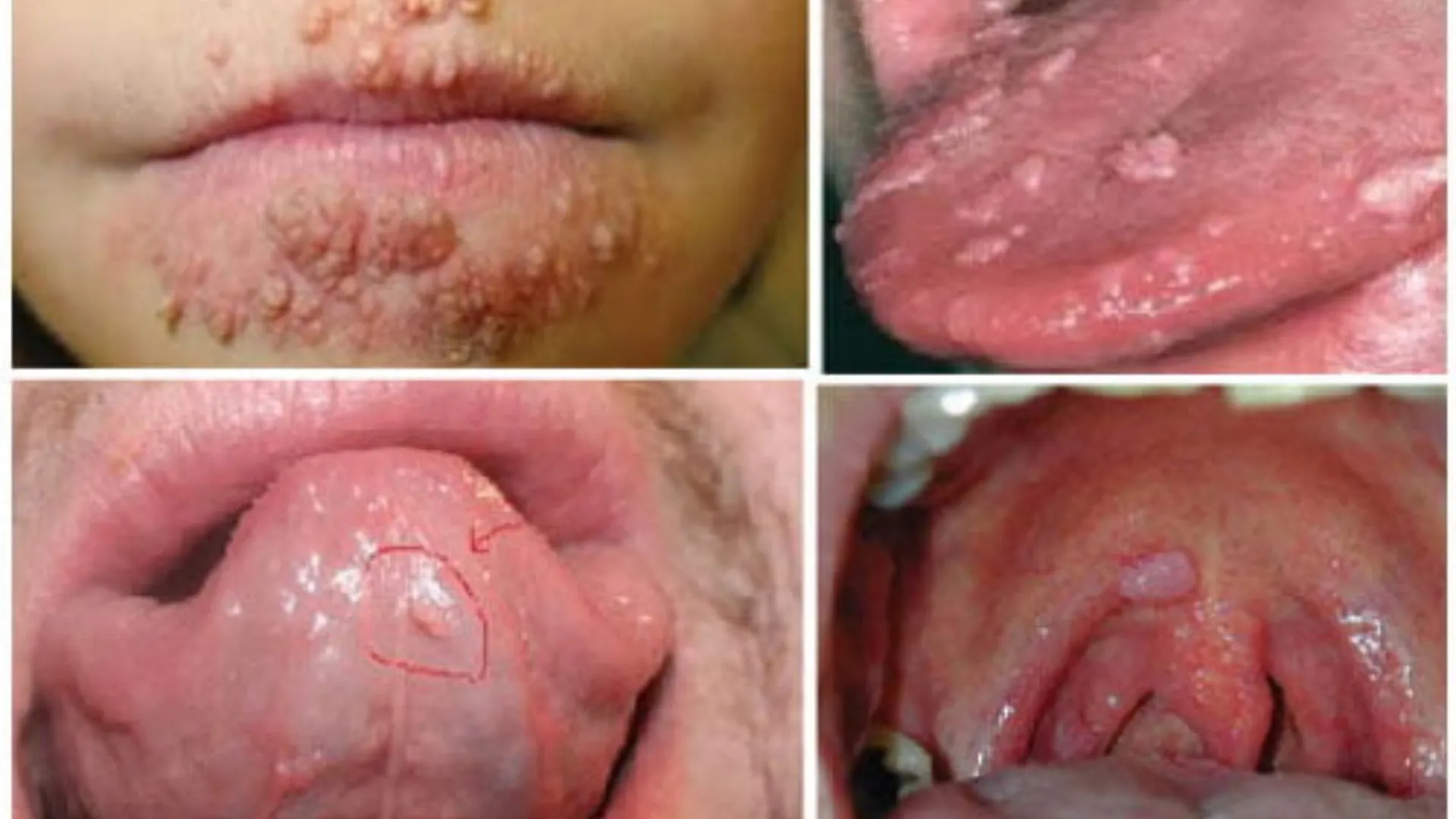 Sùi mào gà ở lưỡi và tất tần tật những gì bạn cần phải biết để tránh