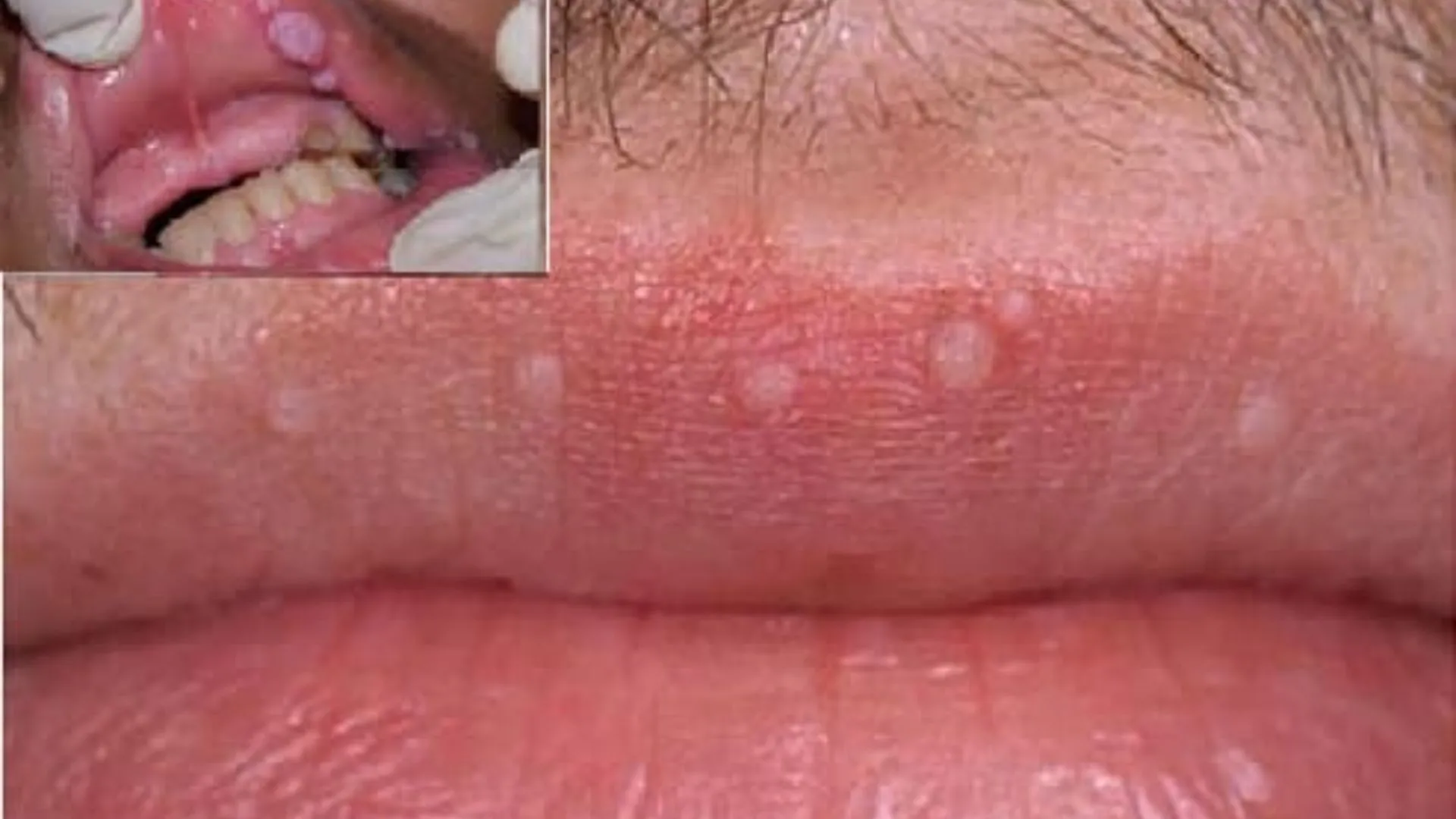 So sánh sùi mào gà ở miệng và nhiệt miệng khác nhau như thế nào?