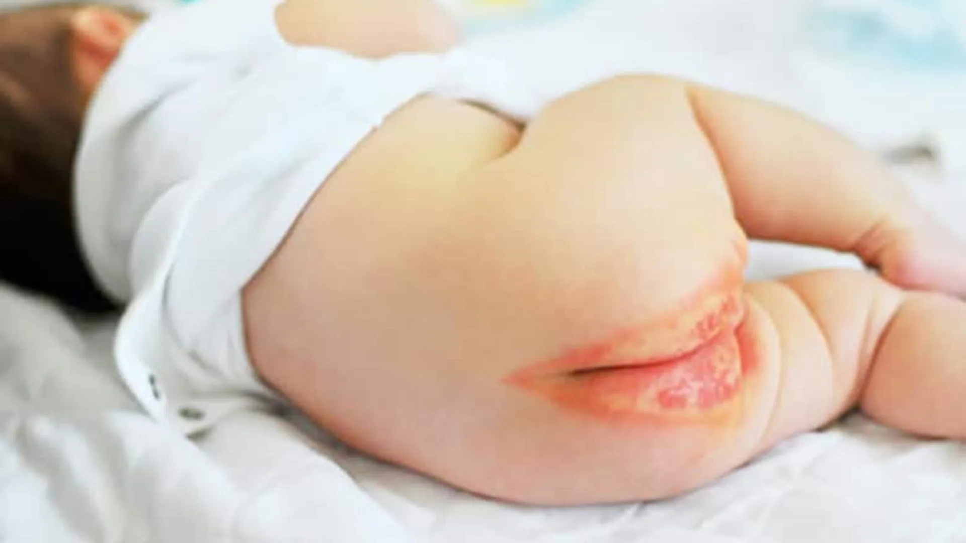 Sùi mào gà ở trẻ em và dấu hiệu cảnh báo phụ huynh cần phải lưu ý