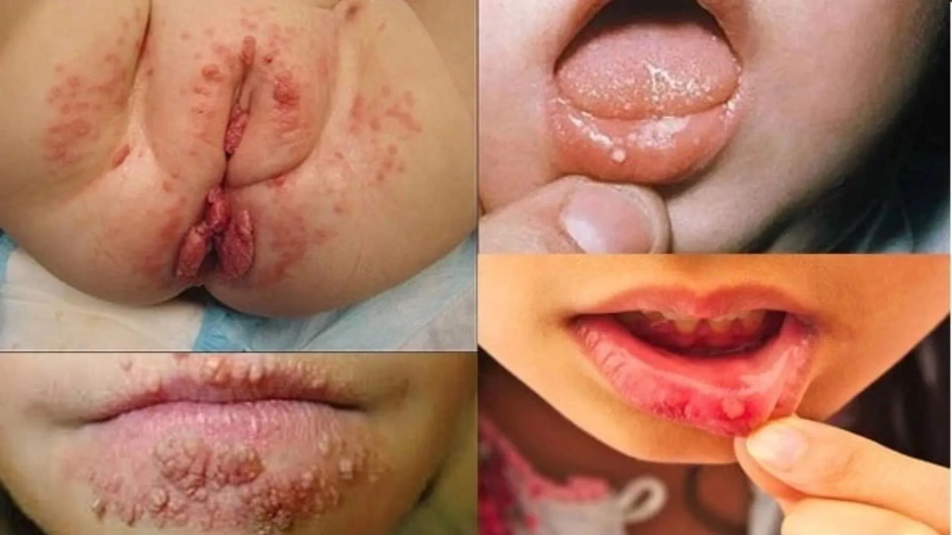 Sùi mào gà ở trẻ em và dấu hiệu cảnh báo phụ huynh cần phải lưu ý