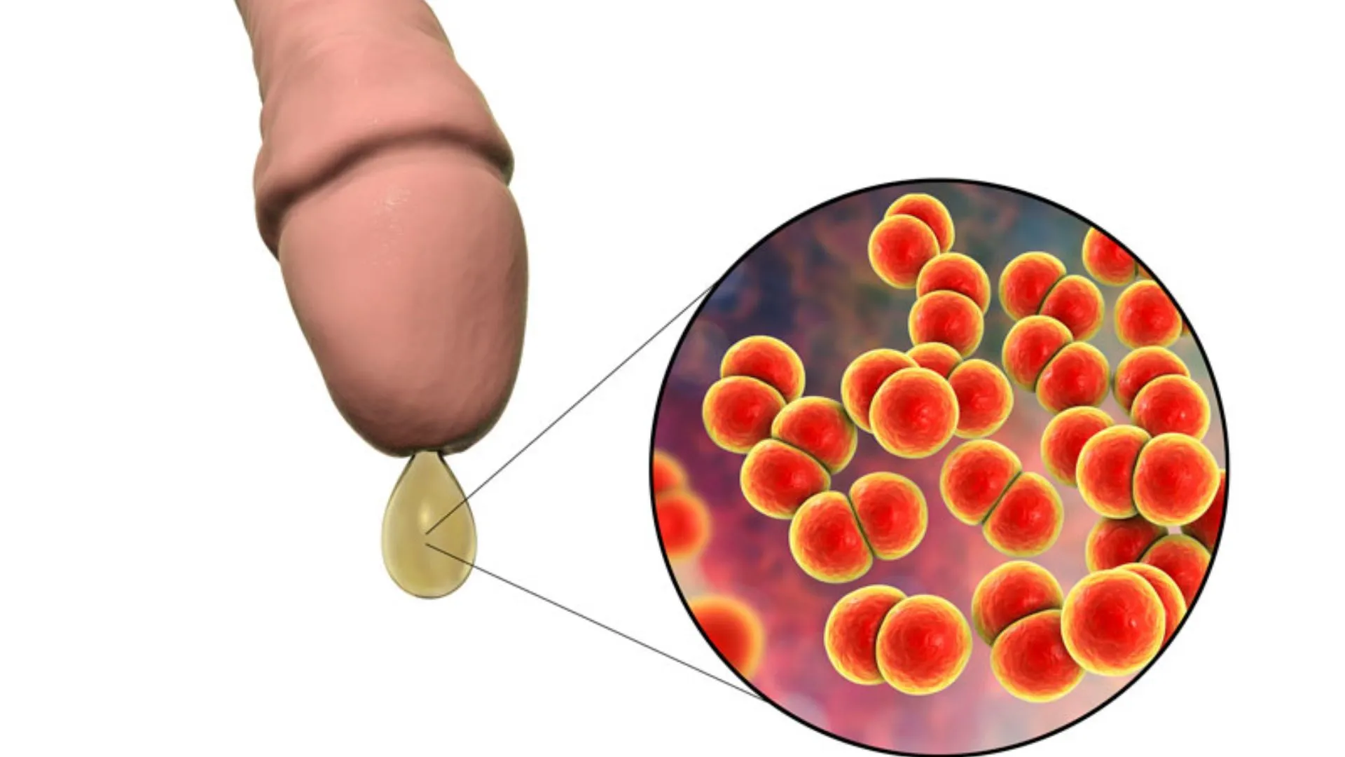 Thời gian ủ bệnh lậu bao lâu và những điều cần biết phòng tránh