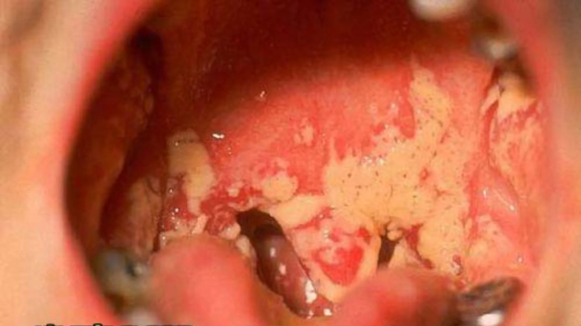 Thời gian ủ bệnh lậu bao lâu và những điều cần biết phòng tránh